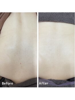 エステ ニキビケア研究所 川崎店/ブライダルエステにもオススメ!