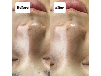 ビトタン 倉敷本店(+美to鍛)/ハーブ×プラズマシャワー