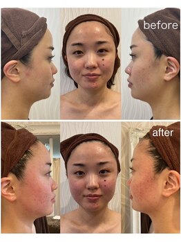 プロラボスパ 渋谷店/20代後半　症例写真