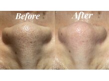 シェリール(Cherir)/小顔矯正+毛穴ケア