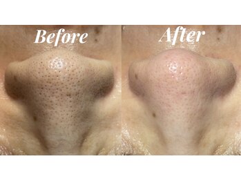 シェリール(Cherir)/小顔矯正+毛穴ケア