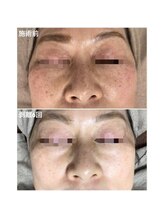 エミルカ 鹿児島店(EMILUCA)/ハーブピーリング