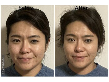 ショウフェイスデザイン(Sho Face Design)/《小顔矯正》ビフォーアフター