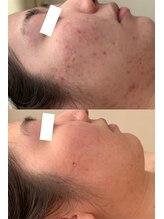 プリュボーテ 吉祥寺(Pul Beaute)/ハーブピーリング