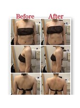 エクルビューティーツー(ECRU Beauty 2)/上半身痩身。結果だします。