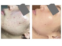 ワイエス サロン 東陽町(Ys Salon)/頑固なニキビケアに