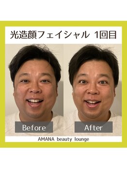 アマナ(AMANA)/シミのケアを佐竹さんも開始!