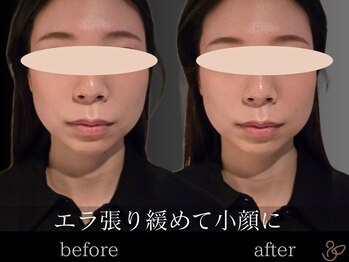 チョコバリ 新宿店(chocobari)/小顔×リフトアップ(美容鍼)20代