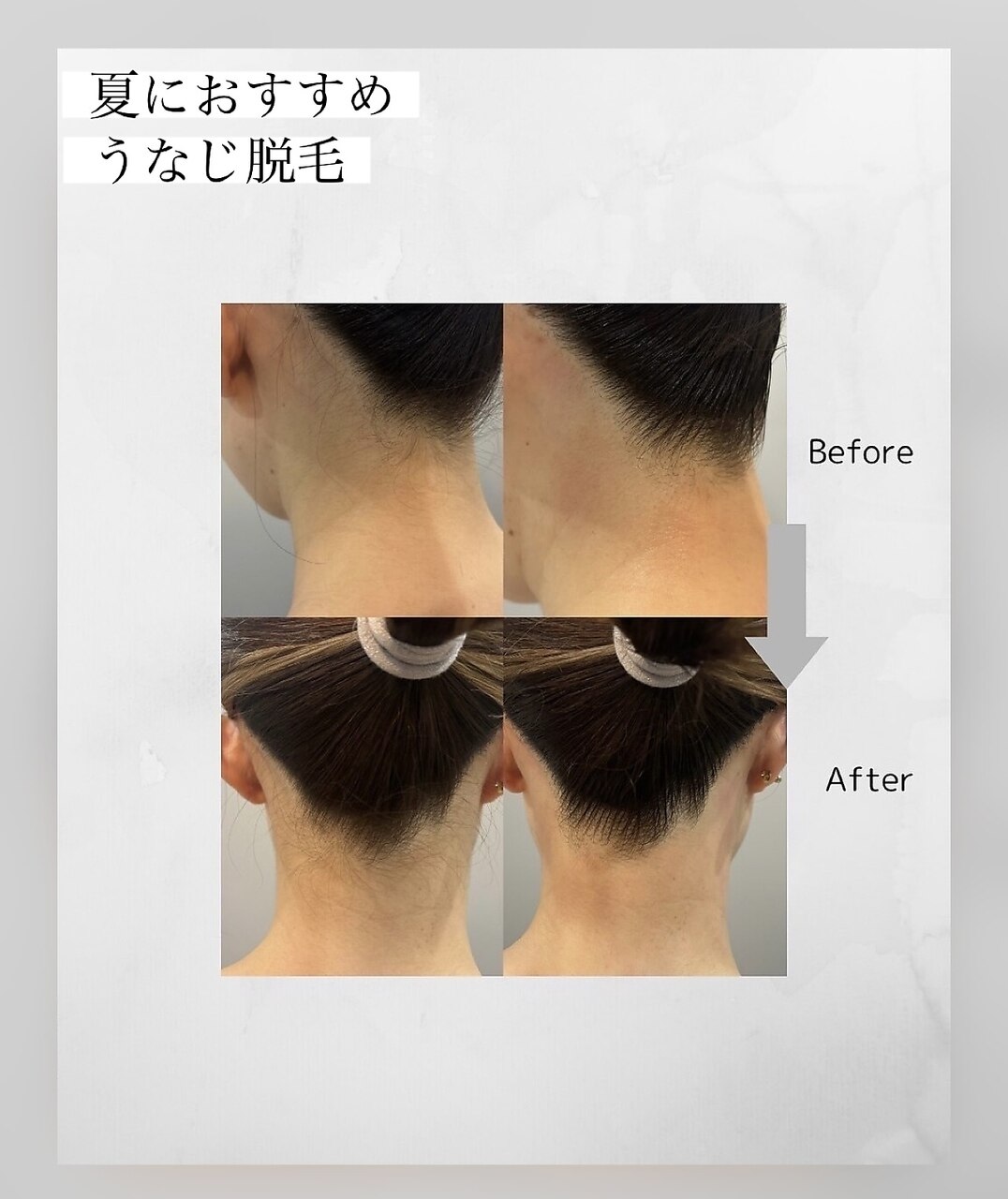 【うなじ脱毛】アップヘア、ショートヘアが映えるうなじ美人\1,500