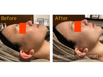 ロイヤリティ(ROYALTY)/ニキビ/お肌の凹凸/毛穴/美白