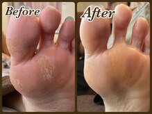 ビューティースパ(Beauty-Spa)/【タコ・ウオノメの角質除去】