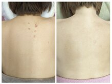 ラミーユ(La Miu)/背中のひっかき傷改善