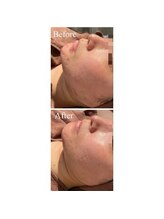 エミルカ 鹿児島店(EMILUCA)/ハーブピーリング