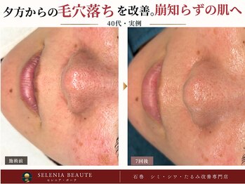 セレニア ボーテ(Selenia Beaute)の写真/昔と違う毛穴悩みに、肌状態から見直す本格ケア