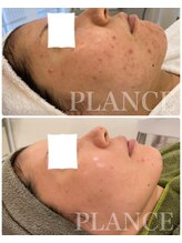 プランス 恵比寿店(PLANCE)/恵比寿/ハーブピーリング/人気