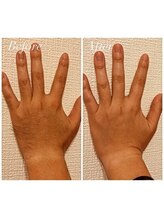 リリウム(Lilium)/脱毛｜手の甲