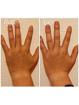 リリウム(Lilium)/脱毛｜手の甲