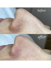 サロン ド ソワン(salon de soin)/毛穴エクストラクション