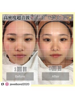 ジュエルボンド(Jewel Bond)/【リフトアップ】