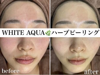 ホワイトアクア 錦糸町店(WHITE AQUA)/ハーブピーリング/東京/錦糸町