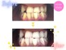 【口コミ特典☆】セルフホワイトニング9分×2セット　¥500