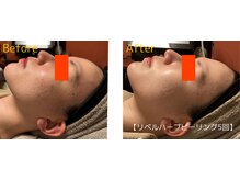 ロイヤリティ(ROYALTY)/ニキビ/お肌の凹凸/毛穴/美白