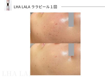 スパレーカ(Spa laka)/ララピール