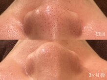 ウォーム(warm)/【肌質改善専門店warm】毛穴洗浄