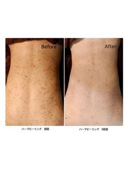 エミルカ 鹿児島店(EMILUCA)/ハーブピーリング