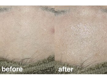 フルミー(fulme.)/ハーブピーリングbefore&after