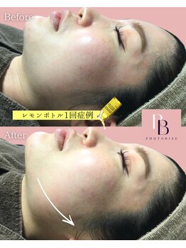 フォトビズ/二重顎もたつき改善レモンボトル
