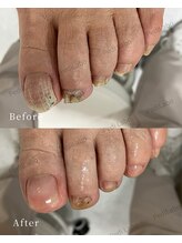 ペディラボ 荻窪店(Pedi Labo)/抗がん剤による爪のトラブル
