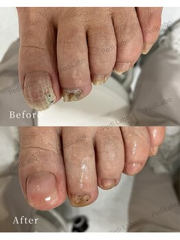 ペディラボ 荻窪店(Pedi Labo)/抗がん剤による爪のトラブル