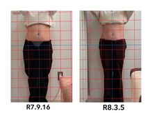 よしの鍼灸整骨院/産後骨盤矯正　　34歳　20回