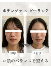 リノ ショウナン(LINO SHONAN)/ポテンツァ×ハーブピーリング