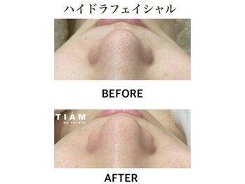 ティアム バイ テトテ 神戸三宮(TIAM by tetote)/毛穴洗浄