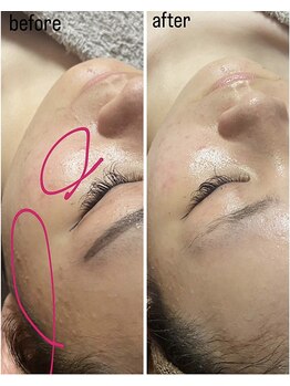 ルカ アンド ステラ(Luca & Stera)/ハーブピーリングビフォーアフタ