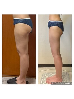 ビボディラボ 海老名店(美Body Labo)/セル撃退