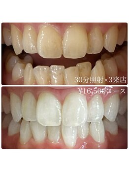 ホワイトニングルーム 川崎店(WhiteningRoom)/ホワイトニング/川崎