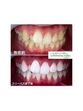 ホワイトニングサロン 名古屋駅店/【ホワイトニング施術例】