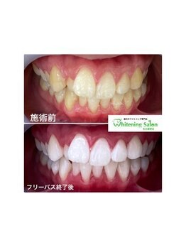 ホワイトニングサロン 名古屋駅店/【ホワイトニング施術例】