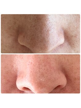 マヴィ 守口店(MavY.)/毛穴改善