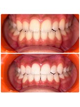 コナホワイトニング 神保町/ホワイトニング