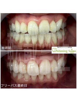 ホワイトニングサロン 広島店/【ホワイトニング施術例】