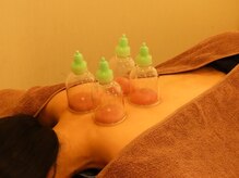 リ フリー 宮の森店(Re'free)/カッピング（吸い玉）