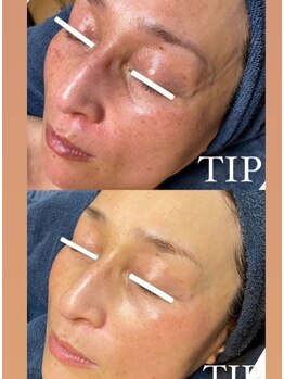 ビーピー 渋谷(b.p.)/TIP ハーブピーリング