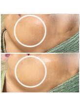 ミロク(MIROKU.)/剥離しないハーブピーリング