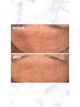 ルアナ(Luana)/【人気NO.1】陶肌トリートメント