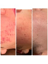 ビーアンドアイ シズオカテン レディース(B＆I SHIZUOKA)/20代女性 ニキビケア3回目