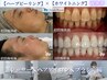 【ハーブピーリング×ホワイトニング】ホットペッパー限定44,050円→30,000円
